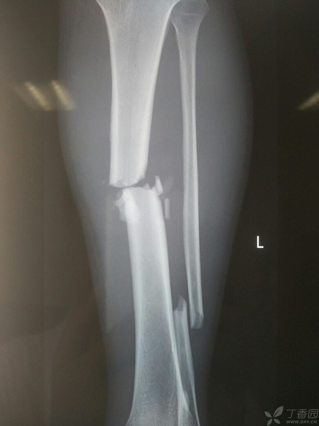 科技重塑脛腓骨骨折康復之旅，引領未來體驗新篇章