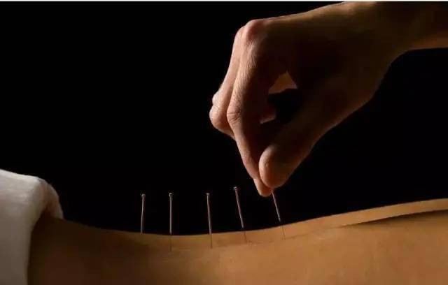 平衡針灸最新視頻，現(xiàn)代應(yīng)用探索針灸藝術(shù)的新境界