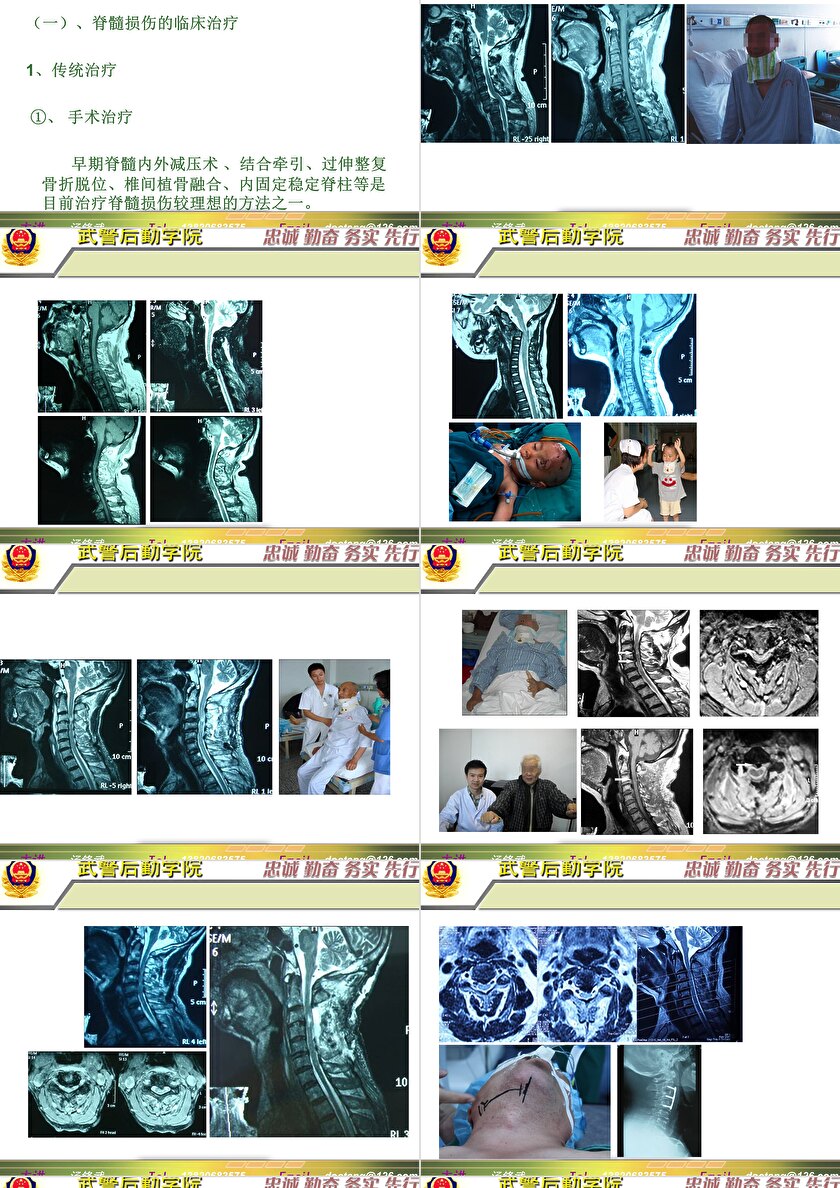 2023年脊髓損傷研究新進(jìn)展，里程碑式的突破與日常奇妙變化