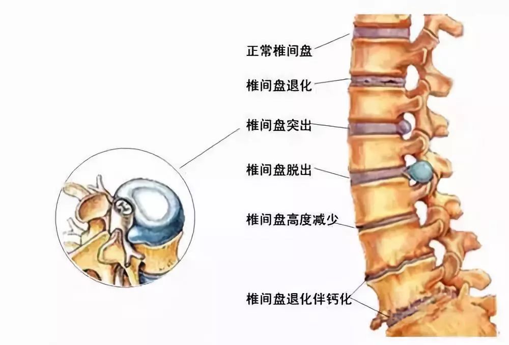 最新腰椎盤與歡樂(lè)大家庭的互動(dòng)日常