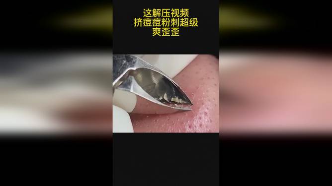 最新擠膿包視頻，見證變化的力量，自信與成就感的誕生之地