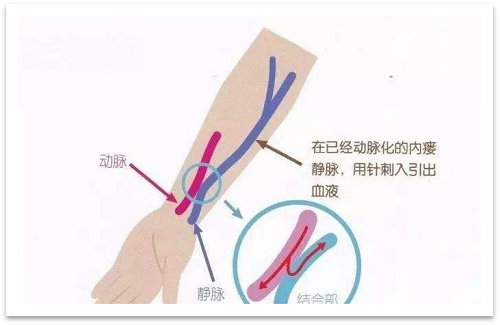 靜脈瘺最新資訊，掌握最前沿的健康信息
